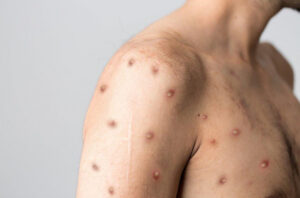 Saúde reforça orientações sobre a prevenção ao Mpox em Canaã dos Carajás